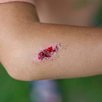 Boala infecțioasă gravă, cu mortalitate ridicată dacă nu este tratată rapid și corect. Sporii care o cauzează pot supraviețui ani de zile