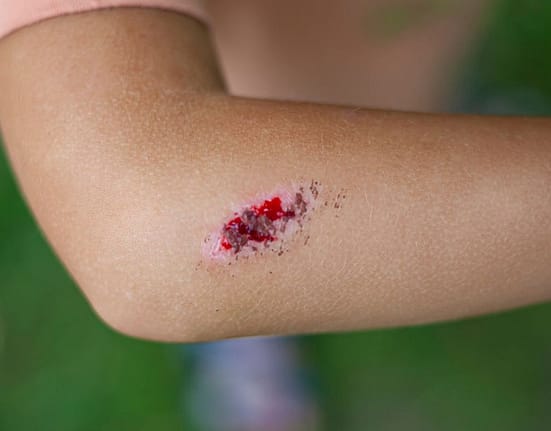 Boala infecțioasă gravă, cu mortalitate ridicată dacă nu este tratată rapid și corect. Sporii care o cauzează pot supraviețui ani de zile