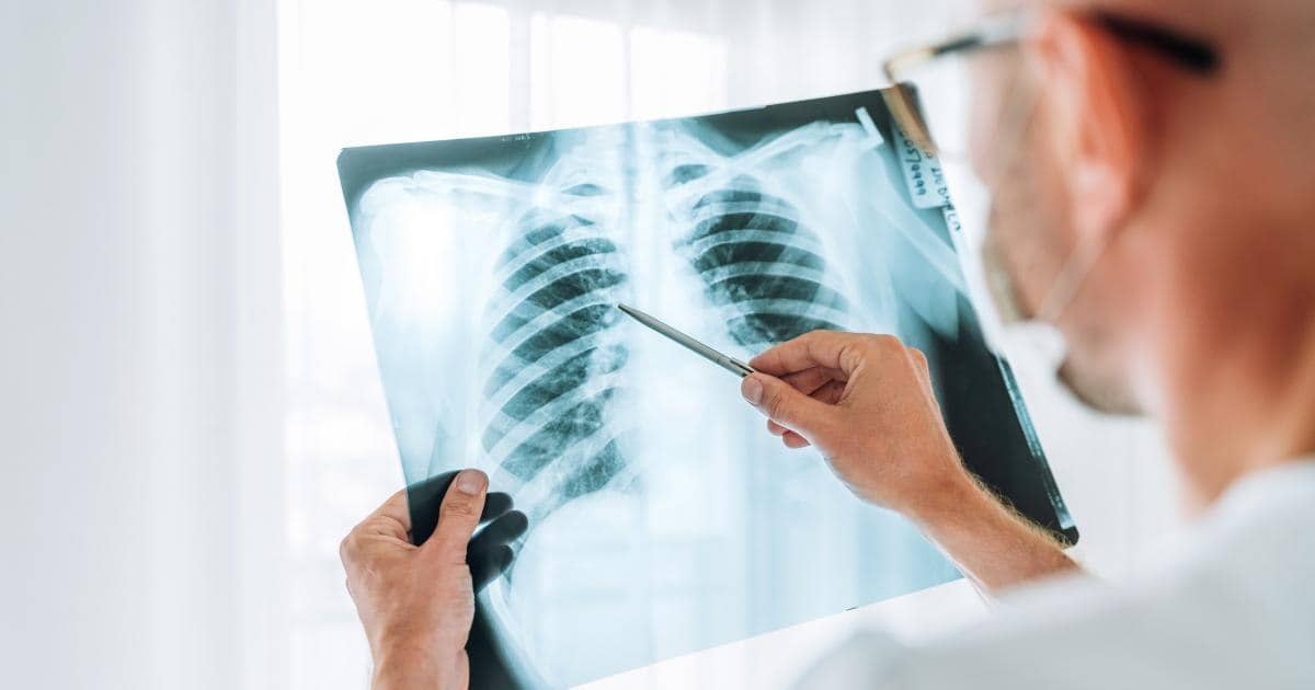 A crescut îngrijorător numărul cazurilor de cancer pulmonar la nefumători. Ce spun specialiştii despre principala cauză
