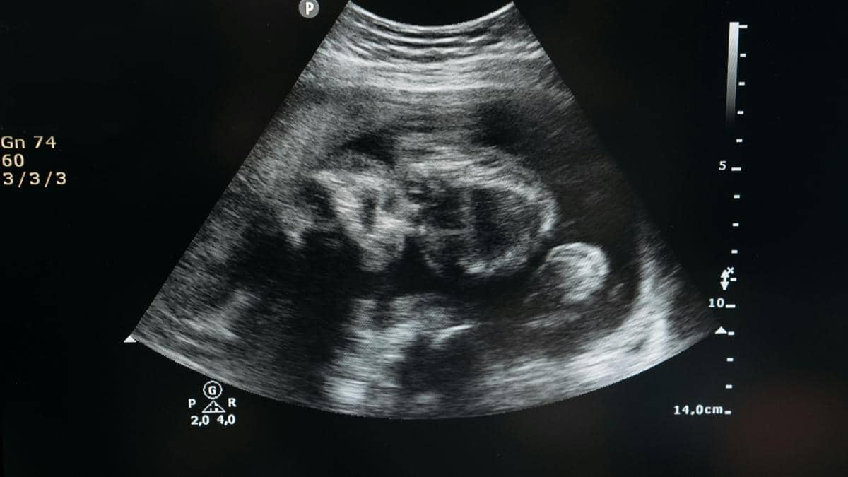 Ce este un lithopedion sau „bebelușul de piatră”? O raritate medicală care fascinează lumea