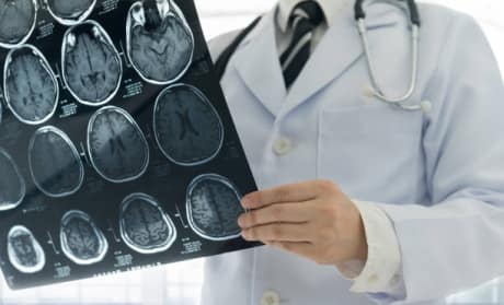 Studiu alarmant: 1 din 5 pacienți cu AVC minor va suferi un nou accident vascular cerebral în următorii 10 ani
