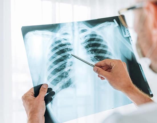 A crescut îngrijorător numărul cazurilor de cancer pulmonar la nefumători. Ce spun specialiştii despre principala cauză
