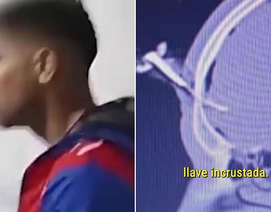 Operat pentru a-i fi extrasă o cheie de mașină înfiptă în cap! Imagini șocante